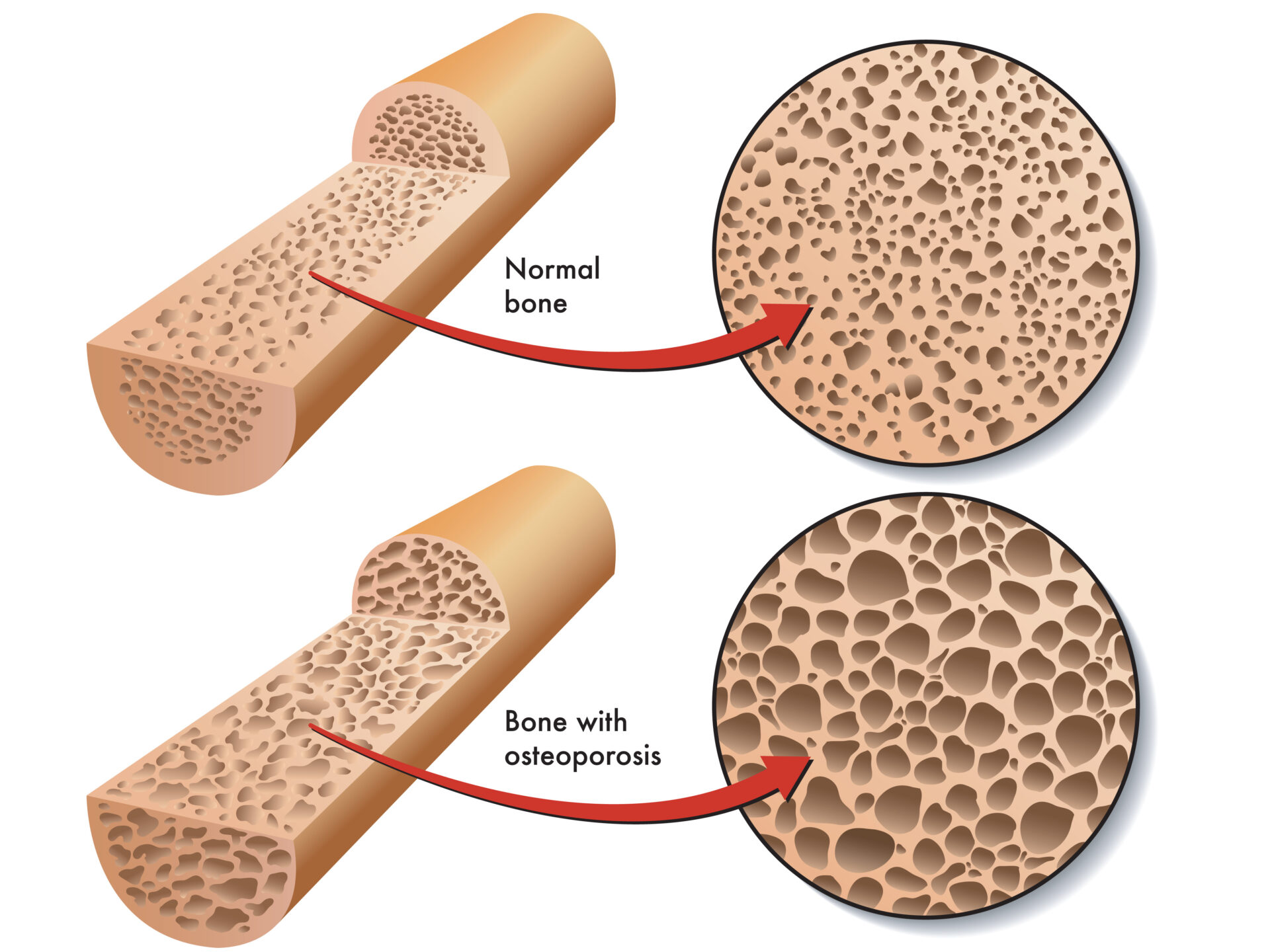How to Manage Osteoporosis